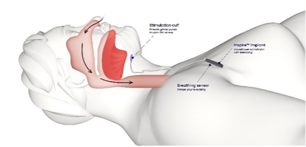 3D Diagram of Inspire sensor is placed for therapy